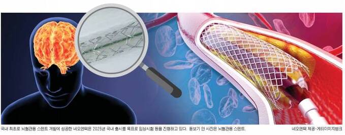 [비바100] "뇌혈관용 스텐트 국산화로 환자 삶의 질 높이겠다" - 뉴스 썸네일 이미지