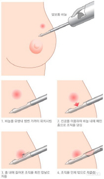 맘모톰시술