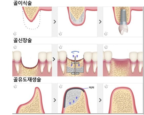 임플란트 불가능한 잇몸뼈 부족