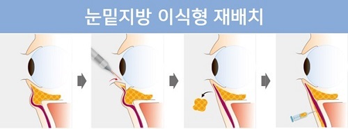 레이저 결막절개식 눈밑지방 이식형 재배치, 생기 있는 효과 오래 지속 - 브릿지경제