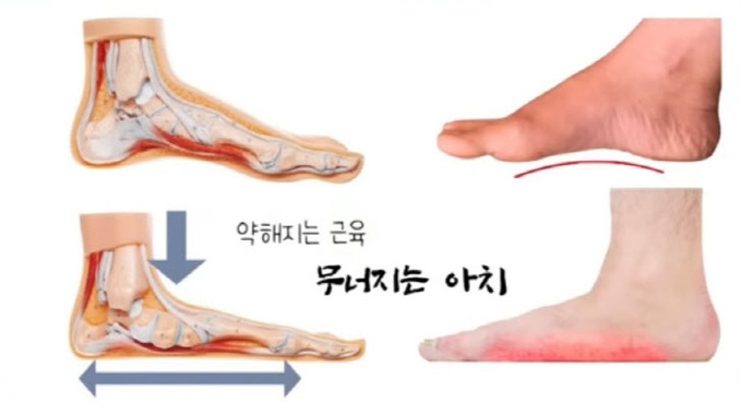 [비바 2080] 신체건강한 노후 맞으려면 3040부터 ‘발 건강’ 챙기세요 - 브릿지경제